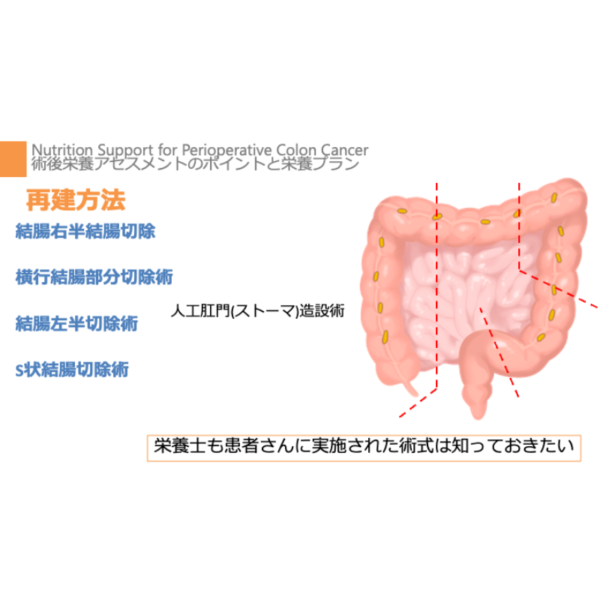 周術期 2/4 | 結腸がんの周術期栄養管理のポイント(※pptxダウンロード可) - 画像 (4)
