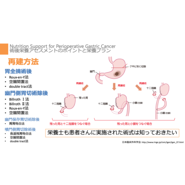 周術期 3/4 | 胃がんの周術期栄養管理のポイント(※pptxダウンロード可) - 画像 (3)
