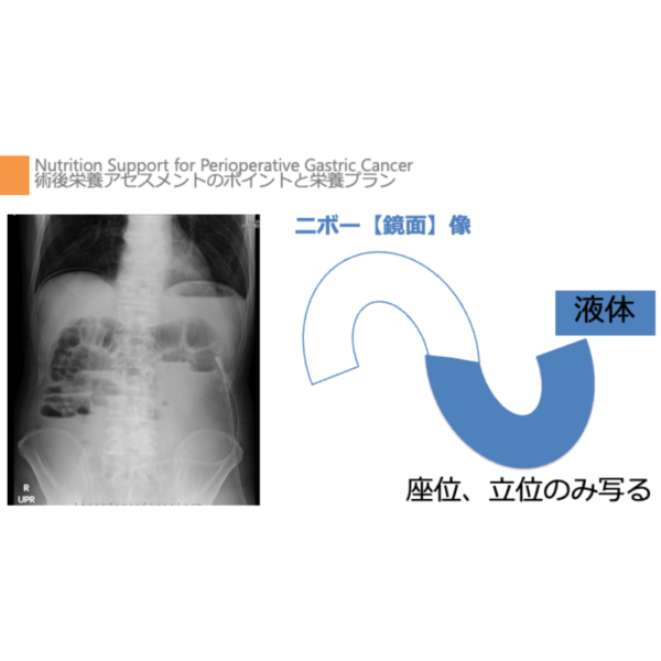 周術期 2/4 | 結腸がんの周術期栄養管理のポイント(※pptxダウンロード可) - 画像 (3)