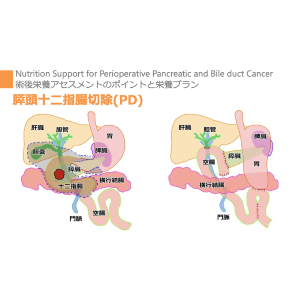 周術期 4/4 | 膵・胆管周術期栄養管理のポイント(※pptxダウンロード可) - 画像 (5)