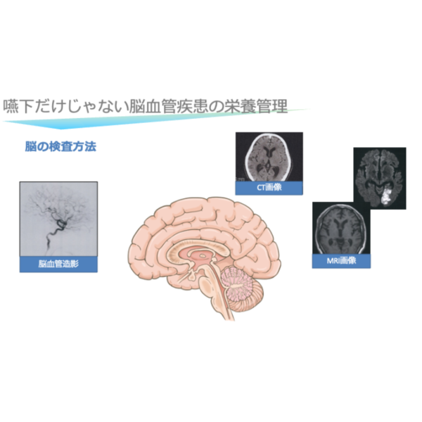脳血管疾患1/4 | 栄養管理に必要な脳血管疾患の基本(※pptxダウンロード可) - 画像 (4)