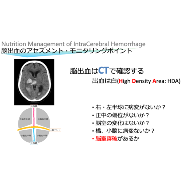 脳血管疾患2/4 | 脳出血の栄養管理(※pptxダウンロード可) - 画像 (3)