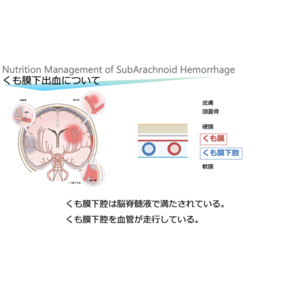 脳血管疾患4/4 | くも膜下出血の栄養管理(※pptxダウンロード可) - 画像 (2)