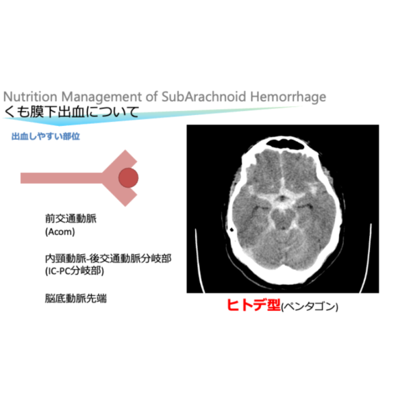 脳血管疾患4/4 | くも膜下出血の栄養管理(※pptxダウンロード可) - 画像 (3)
