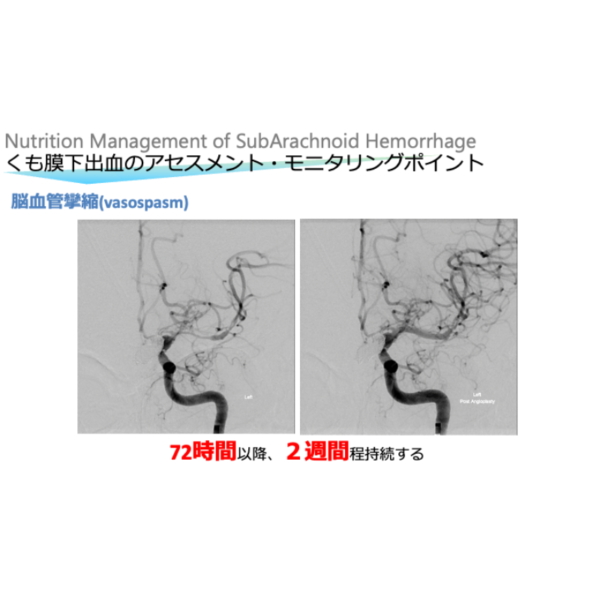 脳血管疾患4/4 | くも膜下出血の栄養管理(※pptxダウンロード可) - 画像 (4)